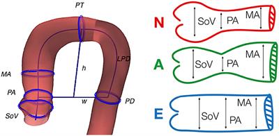 Clinically-Driven Virtual Patient Cohorts Generation: An Application to Aorta